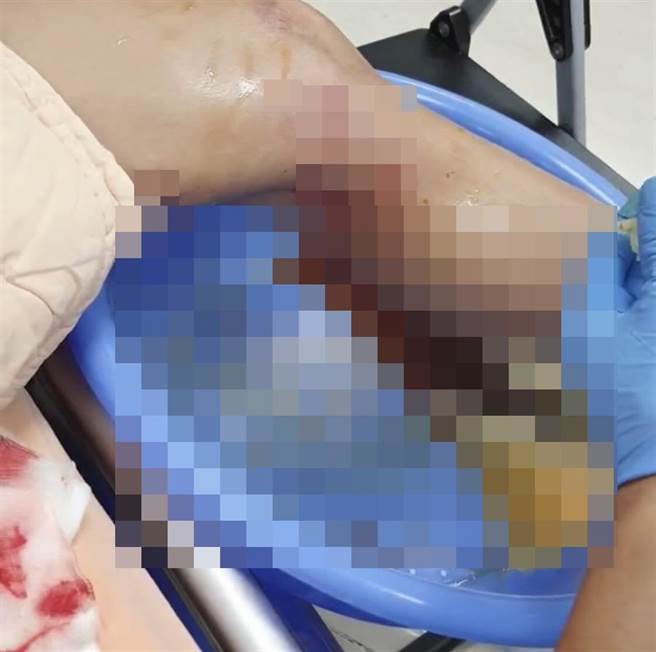 萧富子里长惨遭野狗攻击咬伤，左膝多处咬痕和撕裂伤。（摘自脸书／谢琼云彰化传真）