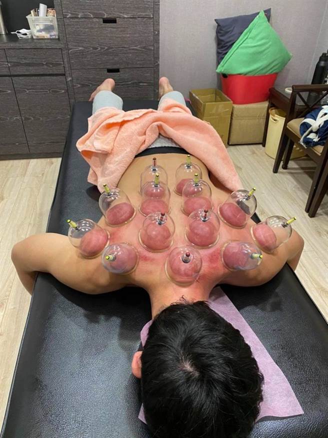 吴慷仁贴出自己正在拔罐的照片 引起许多粉丝的关心 (图/ 翻摄自吴慷仁脸书)