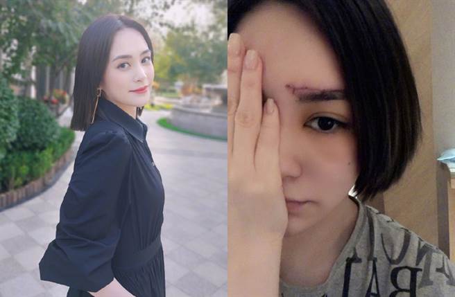 阿娇日前在饭店滑倒爆头，留下蜈蚣型伤疤。（图／翻摄自锺欣潼微博）