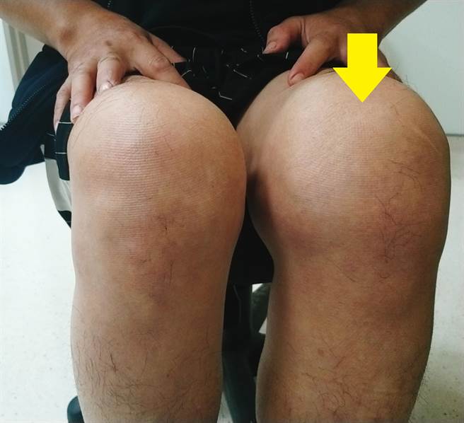 类风湿性关节炎造成患者膝盖关节明显肿胀变形。（图由土城医院提供）