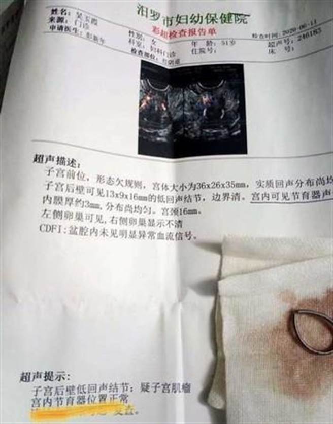 人妻疯狂做人23年才发现避孕环仍留在体内。（图／翻摄自华夏早报）