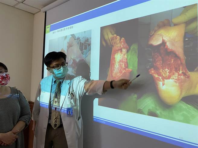中山附医高压氧中心主任林任家指出，何女士右脚伤口因血糖控制不佳，加上穿布希鞋摩擦再度恶化，几乎整只右脚掌严重溃烂。（冯惠宜摄）