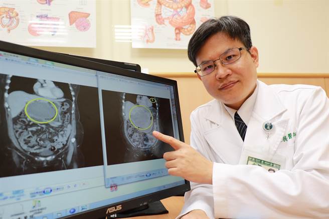 台中慈濟醫院外科部主任余政展說明病人治療前（手指位置）後腫瘤變化。（台中慈濟醫院提供／王文吉台中傳真）