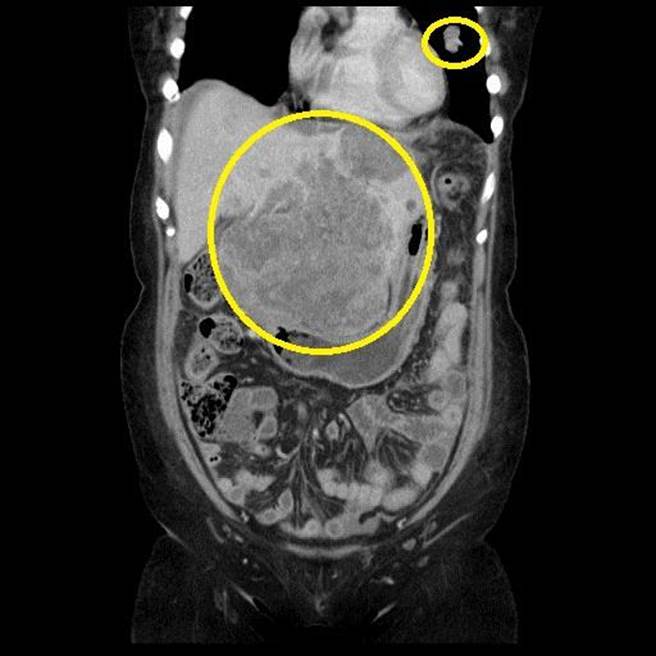 肝癌病患蔡婦術前電腦斷層，可見肝臟巨大腫瘤、散在性小顆腫瘤及上方肺部轉移病灶。（台中慈濟醫院提供／王文吉台中傳真）