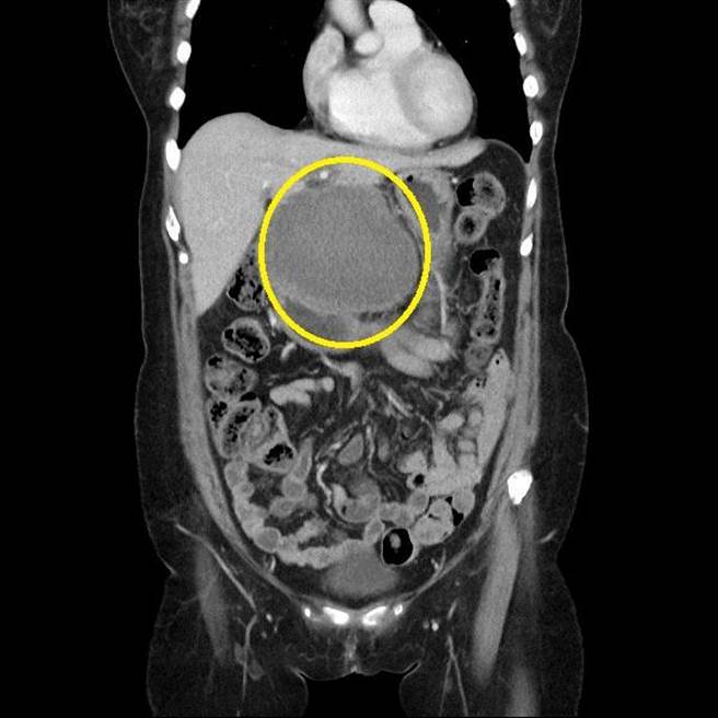 肝癌病患蔡婦術後電腦斷層，原本肝臟腫瘤已消散。（台中慈濟醫院提供／王文吉台中傳真）