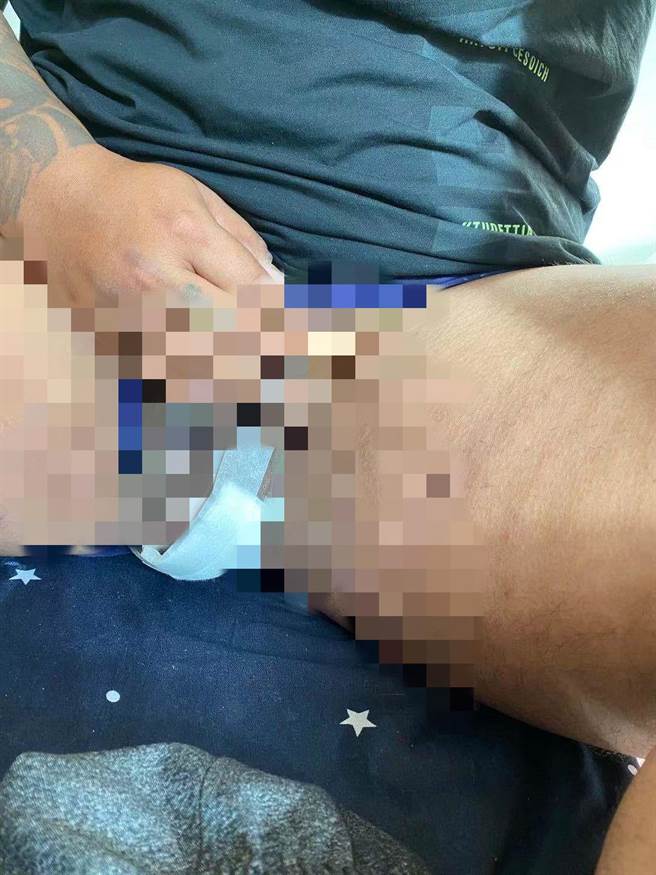 胡姓铁工遭钢筋贯穿阴囊「破蛋」，让他担心无法生育。（民眾提供／罗浚滨新竹传真）