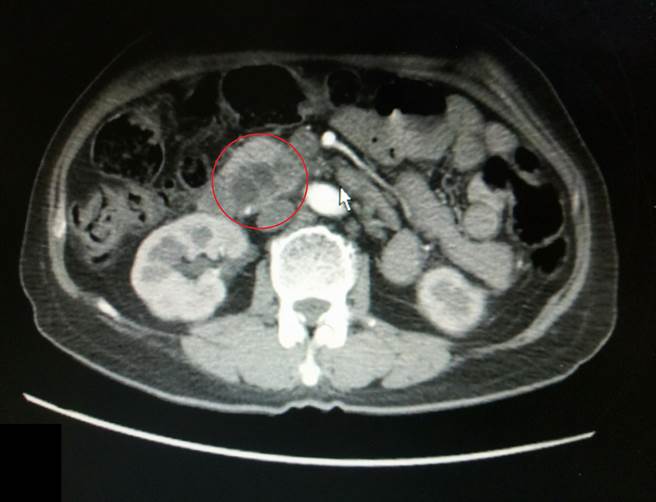 劉女士膽管和胰館都阻塞，且胰臟頭有腫瘤(紅圈處)，切片確診為胰臟癌。（大千醫院提供／何冠嫻苗栗傳真）