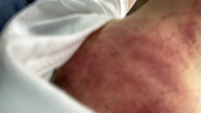 曾莞婷近期为手摇饮店累坏，刮痧背全是瘀血。（曾莞婷工作室提供）