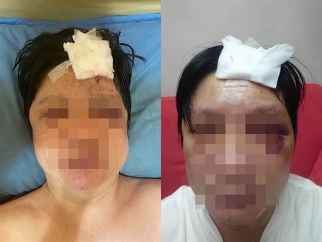 男子控诉被店家强制坐台，多收费用，当下抱怨后遭店家殴打，脸部多处瘀青肿胀。（图／翻摄自脸书爆料公社）