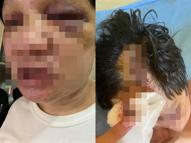 男子控诉被店家强制坐台，多收费用，当下抱怨后遭店家殴打，脸部多处瘀青肿胀。（图／翻摄自脸书爆料公社）