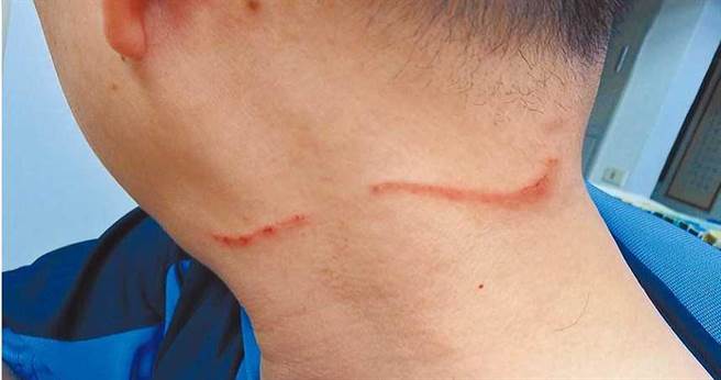 南投看守所管理员被收容人以磨尖筷子攻击，颈部留下伤痕。（南投看守所提供／黄立杰南投传真）