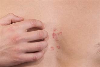 胸前濕疹恐是癌症前兆 台大醫警告：有8大異狀