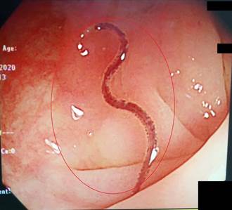 老翁膽管炎反覆發作 2公分寄生蟲藏大腸內