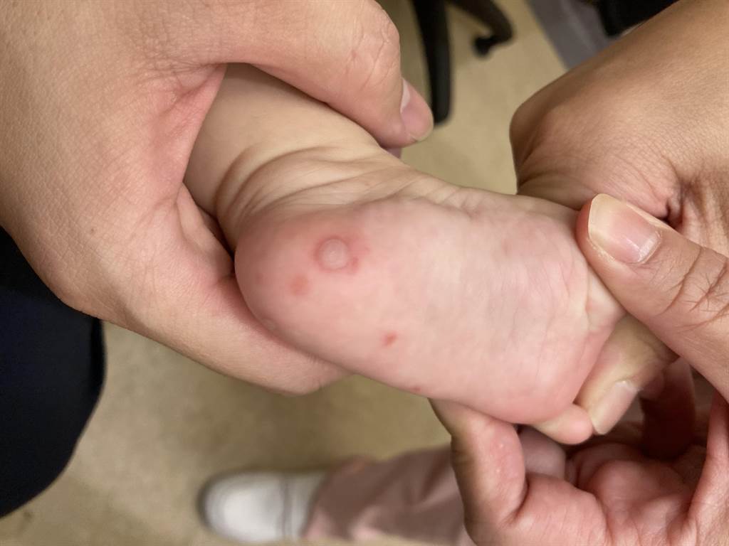 手、足等部位出現零散淡紅斑疹或小水泡疹，是典型腸病毒手口足病 。（大甲李綜合提供／陳淑娥台中傳真）