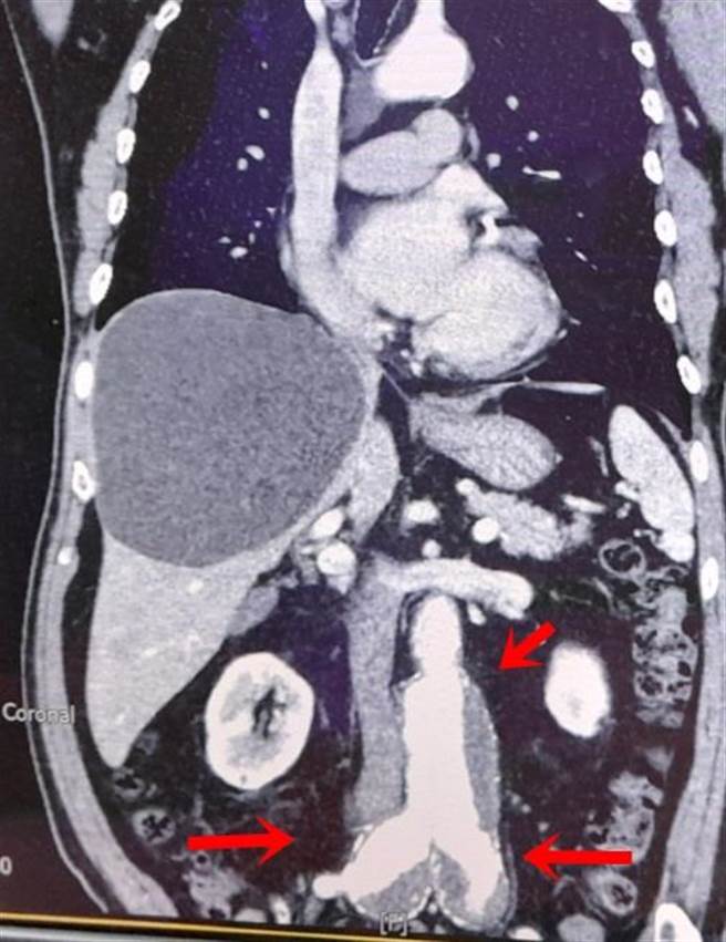 箭头处即为一处腹主动脉瘤与两处肠骨动脉瘤位置。（童综合提供／陈淑娥台中传真）