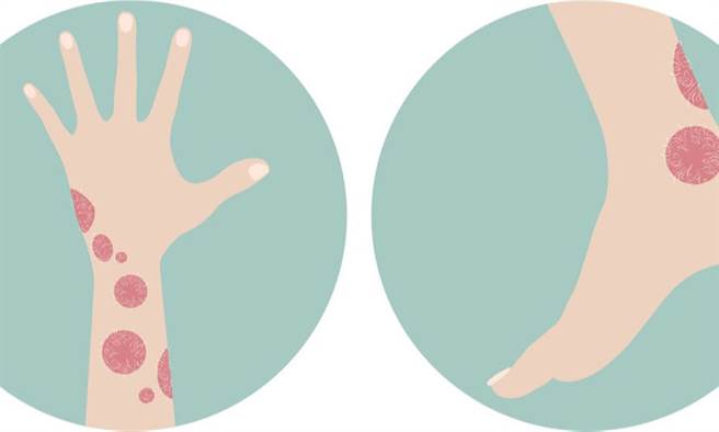 乾癬患者飽受一再復發之苦。(示意圖/Pixabay)