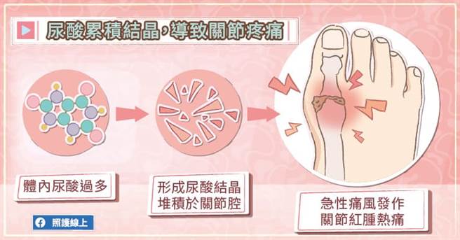 痛风不只让关节疼痛，还会形成「痛风石」，让关节变形。(图/照护线上提供)