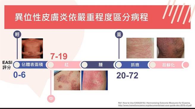 健保有條件給付生物製劑難纏的異位性皮膚炎治療現曙光 健康 中時新聞網