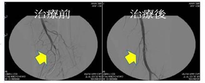 经血管摄影，发现打通前血管明显阻塞，打通后恢復畅通。（台大医院新竹分院提供／邱立雅竹市传真）