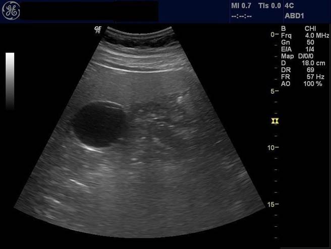 肥胖患者治疗后，肝臟表面光滑，胆囊（左侧黑影）形状明显。（亚大附医提供／陈淑芬台中传真）