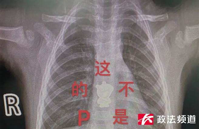 大陆长沙一名女童，在12月24日起床后就开始哭闹，家长带她前往医院看诊后却有惊人发现，女童食道内竟发现佩佩猪身影。(翻摄陆媒)