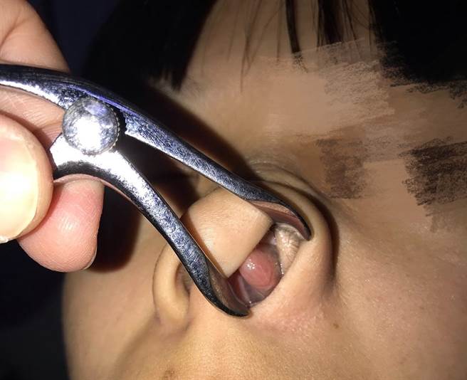 长期使用鼻喷剂，造成鼻甲持续肿胀，鼻塞更严重！（南投医院供／廖志晃南投传真）