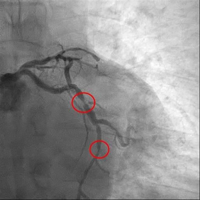 患者冠状动脉阻塞的心导管影像。(亚大医院提供／林欣仪台中传真)