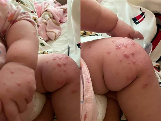 一名妈妈控诉，她的儿子在托婴中心感染肠病毒，导致她的3名儿女陆续都感染，女儿症状最严重，几乎全身、脸上长满水泡。（图／翻摄自脸书爆怨公社）