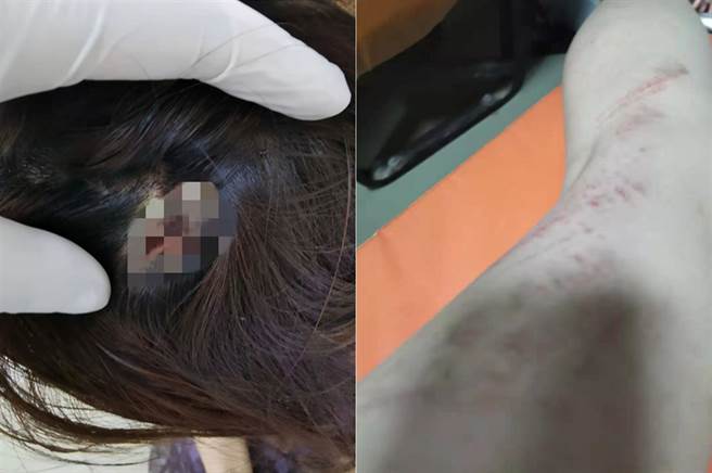 鄭女稱被對方妻子用ipad砸傷頭(圖片取自/網易新聞)