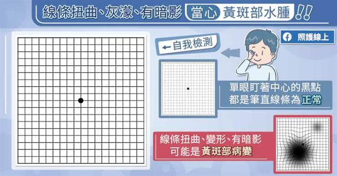 黄斑部水肿简单自我量测。(图/照护线上提供)