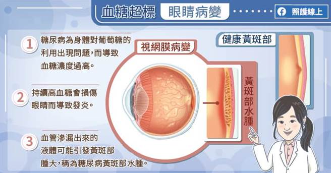 黄斑部水肿若延误治疗时机，有失明的危险。(图/照护线上)