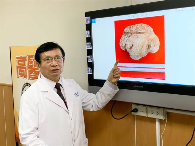 高医泌尿科教授周以和收治一名8旬妇人，取出如棒球大的膀胱结石。（柯宗纬摄）