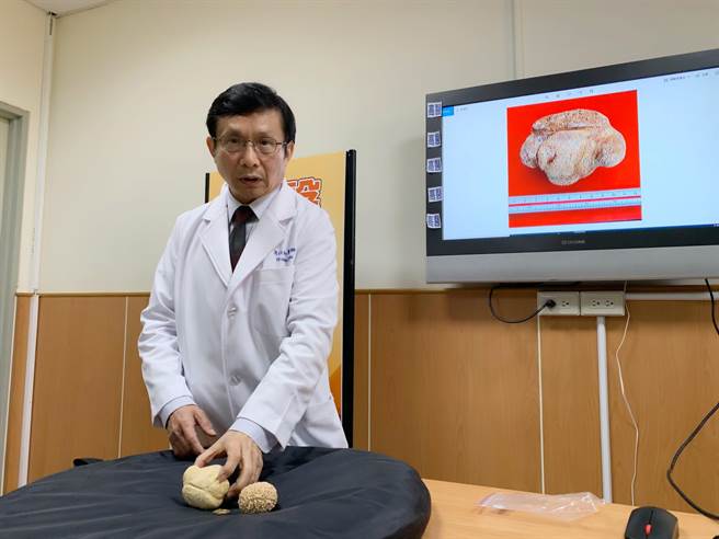高医泌尿科教授周以和收治一名8旬妇人，取出如棒球大的膀胱结石。（柯宗纬摄）