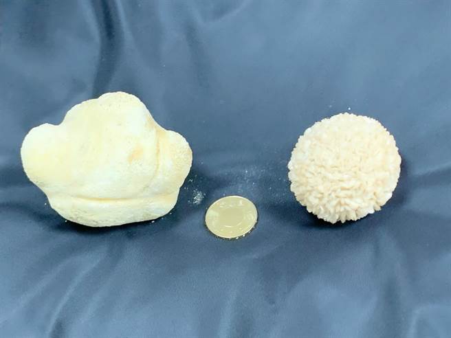 高雄1名8旬妇人膀胱结石如棒球大，医师取出一颗9X7X6公分大的结石，分析成分为感染性结石。（柯宗纬摄）