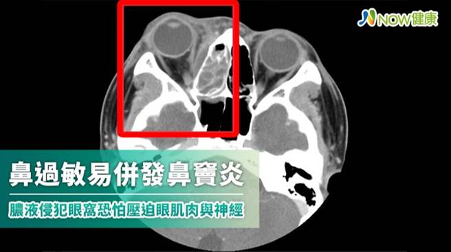 台北慈济医院儿童感染科主治医师吴秉升提醒，鼻子过敏容易併发鼻窦炎，如果未能妥善治疗，脓液有可能蓄积侵犯到眼窝导致压迫。（图／台北慈济医院 NOW健康提供）