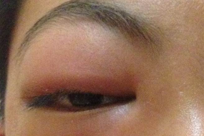 眼窝周边异常肿大眼球转动异常，就有可能因鼻窦炎，导致脓液压迫到肌肉或神经。（图／台北慈济医院 NOW健康提供）