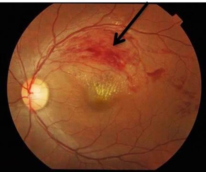 曾男被检查出左眼视网膜膜出血（箭头处），也就是俗称的眼中风。（苗栗医院提供／何冠娴苗栗传真）