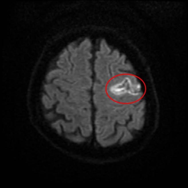 王姓患者经核磁共振检查，影像中以红色圈出缺血性脑中风位置。（亚大医院提供／林欣仪台中传真）