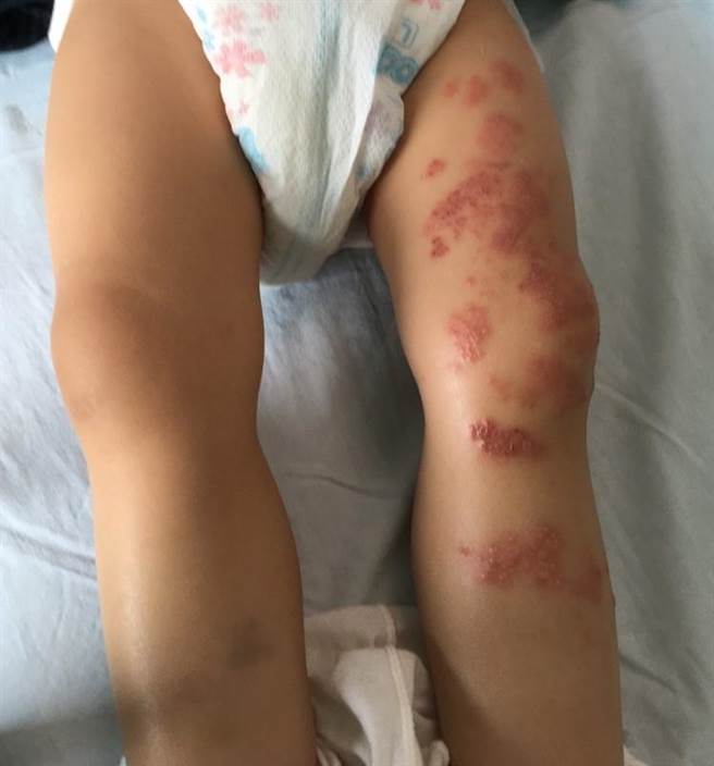 台南一名1岁11个多月女孩诊断罹患带状疱疹(俗称皮蛇)，非常罕见。(郭综合医院提供／曹婷婷台南传真)