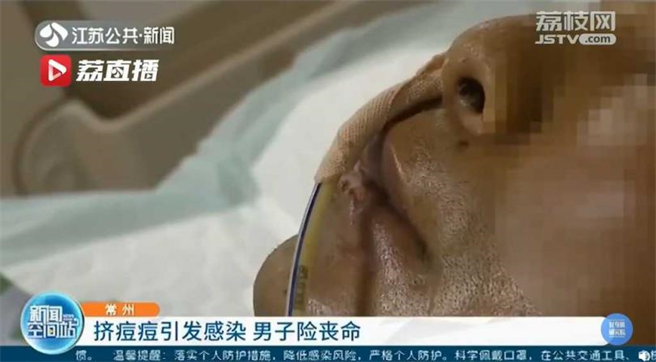 中国一男子挤痘却住进加护病房，情况相当危急。（图／翻摄微博／头条新闻）