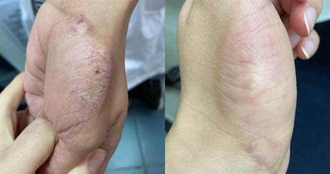 医师分享治疗湿疹妙招。（图／翻摄自江守山医师脸书）