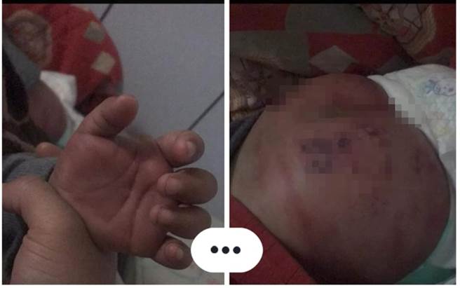 网友PO出3岁童伤势。（翻摄自爆料公社）