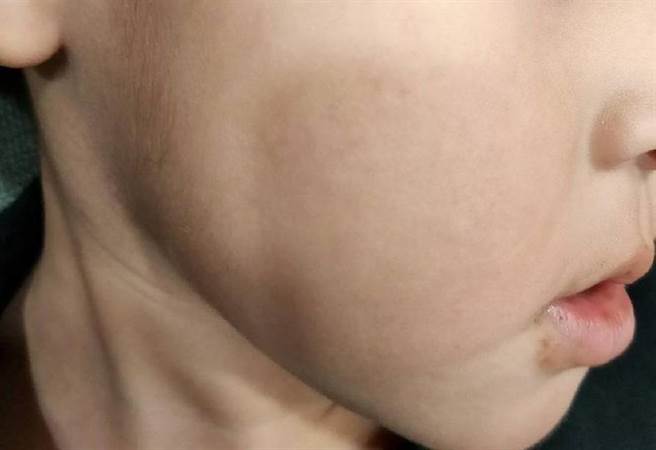 3歲男童臉頰紅腫，家長質疑幼兒園老師打傷。(民眾提供／曹婷婷台南傳真)