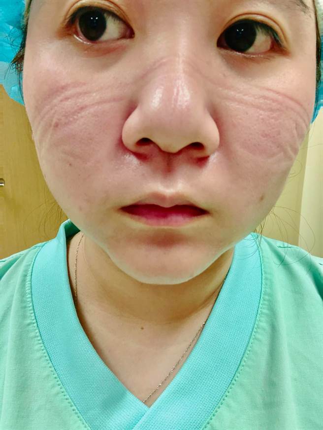 林男透露，太太在桃医的每一刻都要战战兢兢，脸上更布满口罩压痕。（图／当事人授权提供）