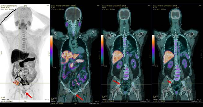 奥摄敏全身正子影像检查，精准找出72岁患者右边淋巴结不只1颗转移，另外还有3颗微小且位置偏远的转移淋巴结，甚至左侧耻骨还有骨转移的情形，各种不同角度之检查影像，红箭头为肿瘤处。（童综合医院提供／陈淑娥台中传真）
