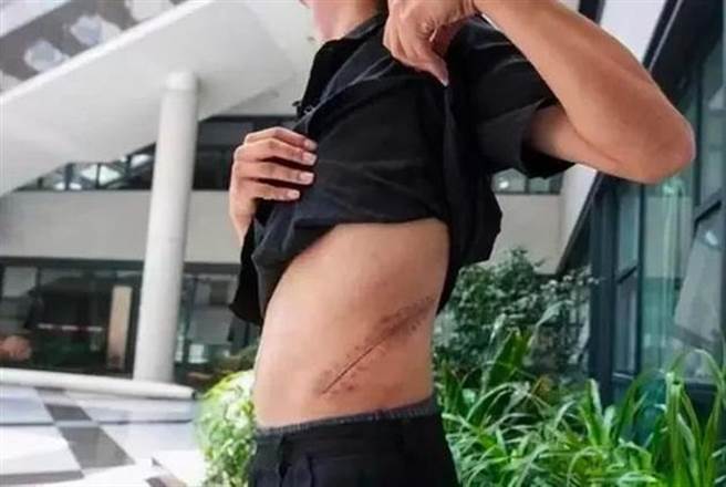 大陆安徽一名高中生在2011年卖肾买iPhone4s手机，如今现况曝光，伤口恶化导致终日卧病在床，或医院赔偿6百多万。（图／翻摄网易新闻）