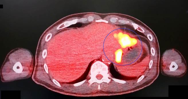 吴先生的正子造影检查，显示胃有肿瘤且合併肝转移(蓝圈内亮黄色区块)。（大千医院提供／何冠娴苗栗传真）