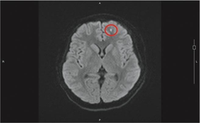 沈积在脑部左边额叶脂肪粒（红圈处），导致少年出现情绪症状。（光田综合医院提供／陈淑娥台中传真）