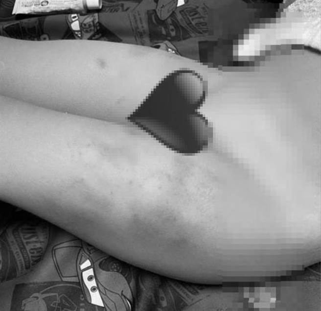 2岁童幼儿园遭虐双腿多处淤青 下手园长否认体罚 家长怒告（翻摄 脸书粉专 靠北幼儿园）