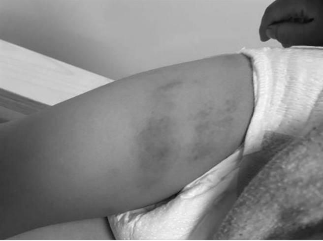 2岁童幼儿园遭虐双腿多处淤青 下手园长否认体罚 家长怒告（翻摄 脸书粉专 靠北幼儿园）